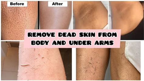 Exfoliates and Removes Dead Skin Cells: