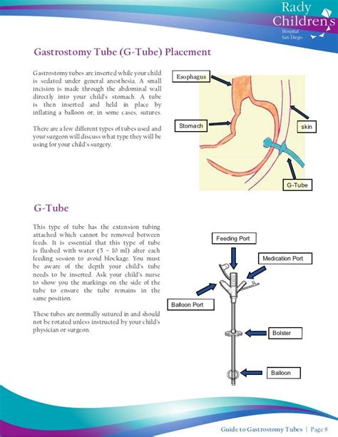 Exploring Gastrostomy Tubes: A Comprehensive Guide to Types and Applications