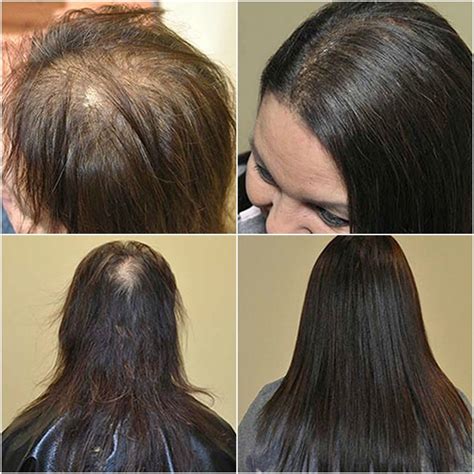 Extensions Thinning Hair: 5 Ways to Prevent & Reverse