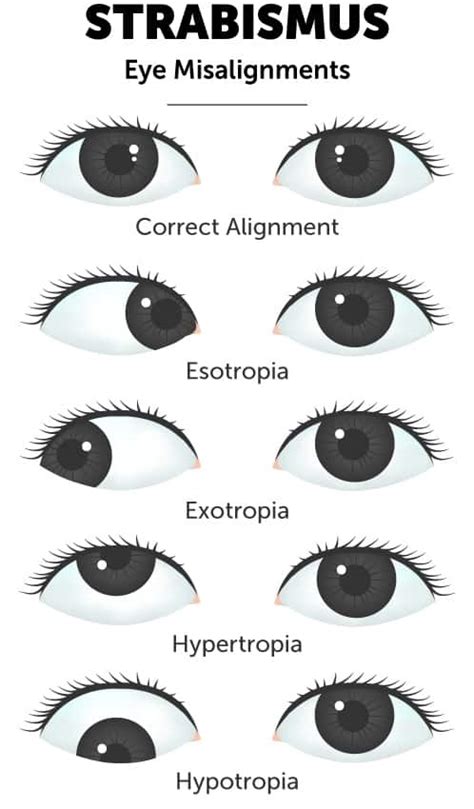 Eyes Not Aligned: A 10,000+ Character Exploration of a Common Eye Condition