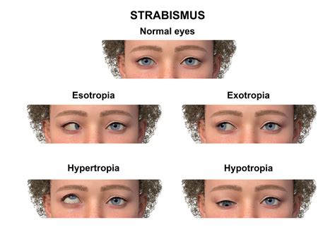 Eyes Not Aligned Mem (5) Types of Strabismus Explained