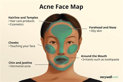 Face Pimples Chart