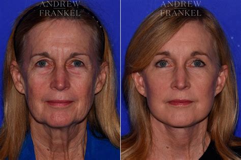 Facial Rejuvenation: