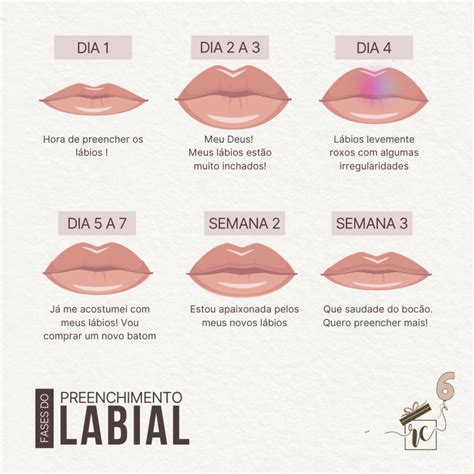 Fases do Pós-Preenchimento Labial