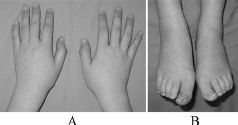 Feet to Hands: The Remarkable Transformation of Hands and Feet