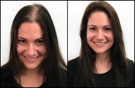 Female Wigs: A Lifeline for 100 Million Women Facing Hair Loss