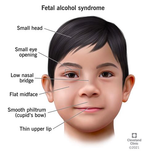 Fetal Alcohol Abuse Syndrome Doc