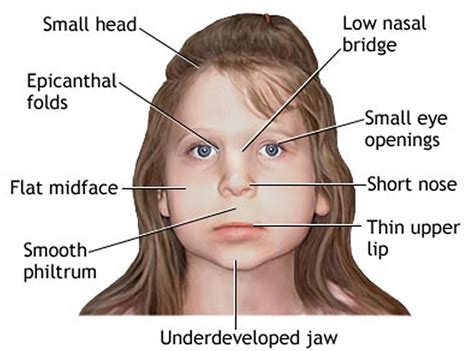 Fetal Alcohol Syndrome Reader