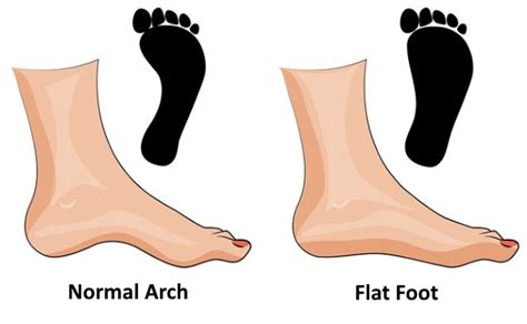 Flat Foot in the Army: A Comprehensive Guide