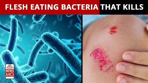 Flesh-Eating Bacteria: A Harrowing Reality