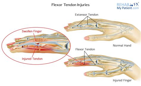 Flexor Tendon Injuries PDF