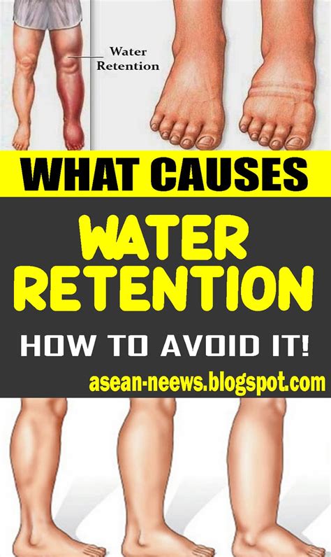 Fluid retention: