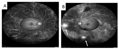 Fluorescein Angiography A User's Manual Reader