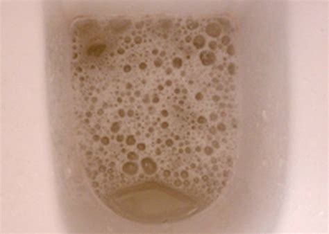 Foamy Urine: