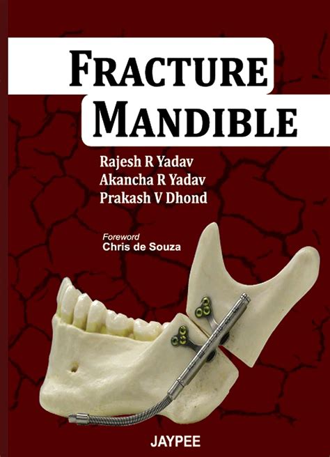 Fractures of the Mandible Ebook Epub