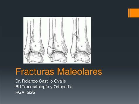 Fraturas maleolares: