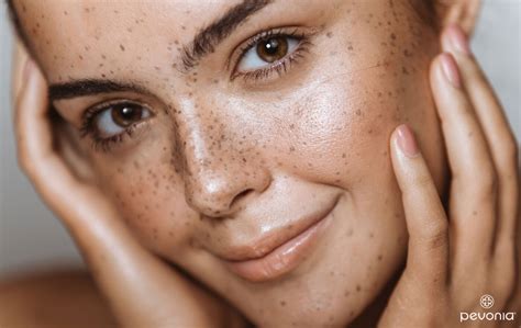 Frecklemonade: Embracing Your Freckles for a Radiant Complexion