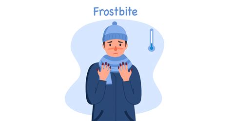 Frostbite: A Comprehensive Guide to Causes, Symptoms, and Treatment