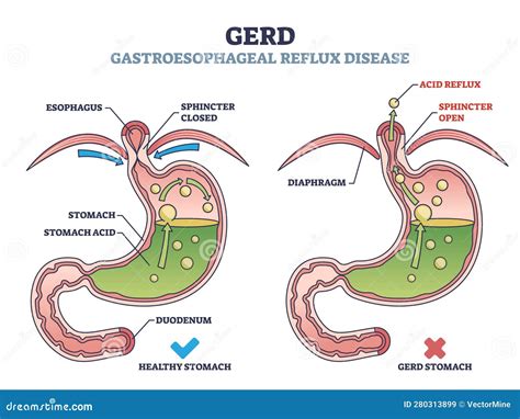 GERD Fainting: A Cause for Concern