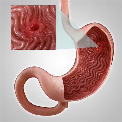 Gastric ulcers: