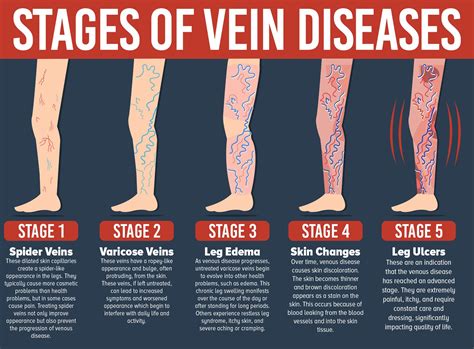 Get Rid of the Blues Everything you always wanted to know about Varicose and Spider Veins But Didn t Know Who to Ask Reader