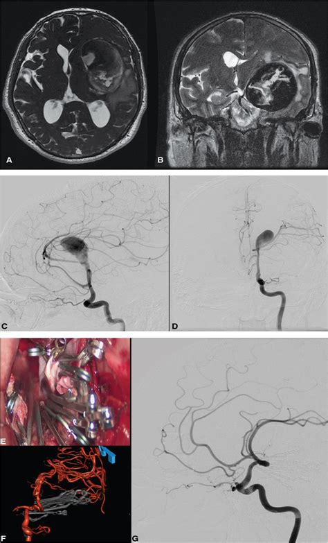 Giant Intracranial Aneurysms Reader