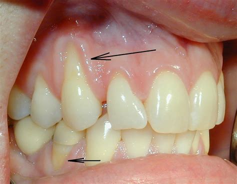 Gingival Recession