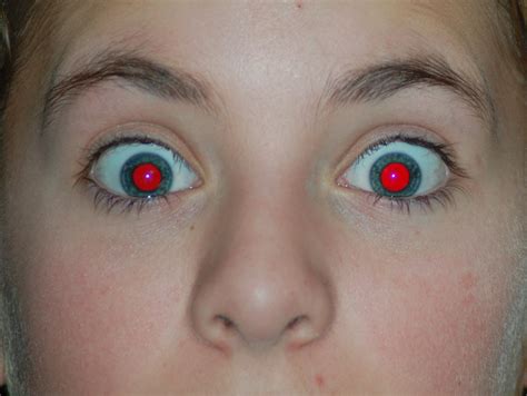 Girls with Red Eyes in Real Life: A Medical Mystery