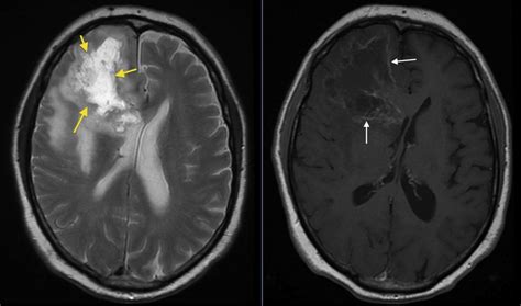 Glioblastoma Multiforme: A Jornada da Esperança e Resiliência