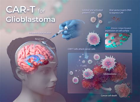 Glioblastoma Treatment Revolution: The Promise of GTRX