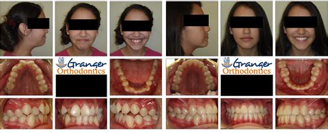 Granger Orthodontics: Revolutionizing Smiles in West Valley