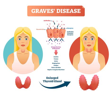 Graves Disease Pathogenesis and Treatment PDF