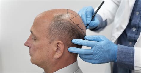 Growing Popularity of Non-Surgical Hair Replacement: