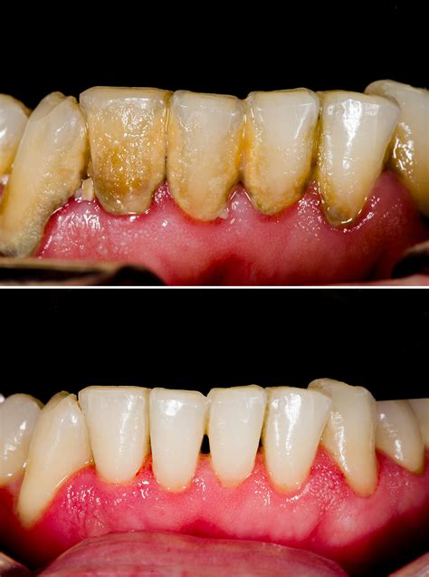 Gum Disease and Tooth Decay