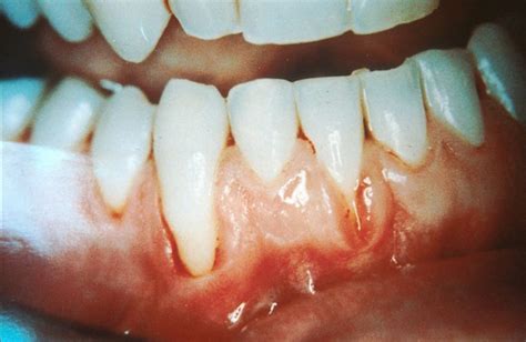 Gums Turning White: Causes, Treatments, and Prevention