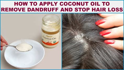 Hair Care (Prevention of Dandruff & Bald PDF