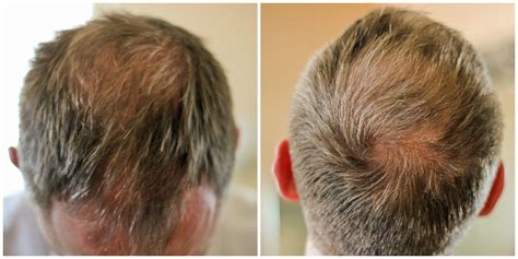 Hair Damage and Thinning: