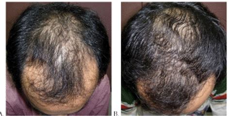 Hair Loss on Top of Head: 10,000+ Solutions to Reverse Balding