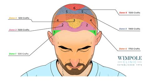 Hair Loss on Top of Head: 10,000 Questions You Need Answered