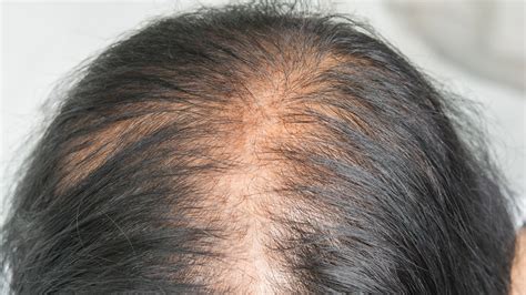 Hair Loss on Top of Head: A 3,000-Year-Old Issue