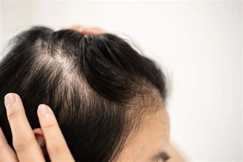 Hair Loss on Top of Head: A Comprehensive Guide to Understanding and Treating Androgenic Alopecia