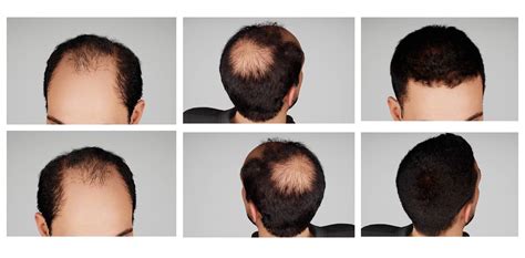 Hair Loss on Top of Head: A Guide to Causes, Treatments, and Prevention