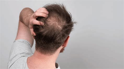 Hair Loss on Top of Head: An In-Depth Guide