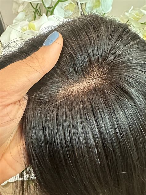 Hair Loss on Top of Head: Understand the Truths and Seek Solutions