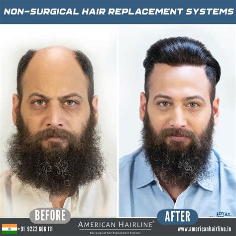 Hair Replacement: 50,000+ Men Can't Be Wrong