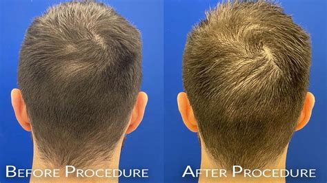 Hair Replacement Chicago: A Comprehensive Guide to Hair Restoration Solutions