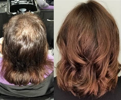 Hair Replacement Chicago: Solutions for Natural-Looking, Confidence-Boosting Transformations