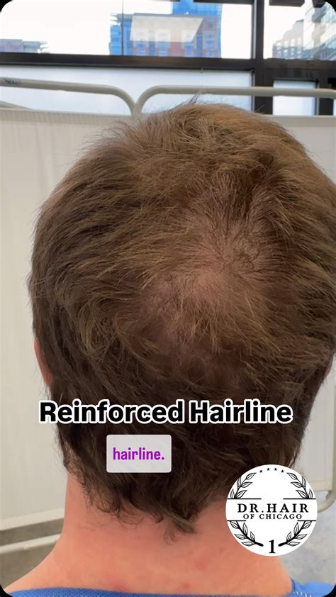 Hair Replacement Chicago: Take Control of Your Hairline with Expert Solutions