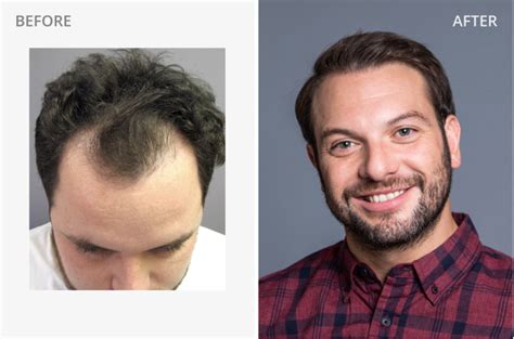 Hair Replacement Men: 50+ Solutions to Regrow, Restore & Replace