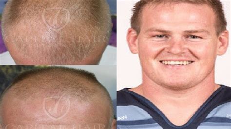 Hair Replacement for Men: 10,000+ Comprehensive Guide to Restoring Your Locks